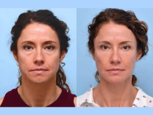 Thread Lift Treatments in Dubai: Face Contouring for Natural-Looking Results