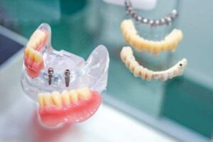 dental implants Dunfermline

