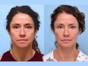 Thread Lift Treatments in Dubai Restore Confidence and Provide Instant Youthful Definition