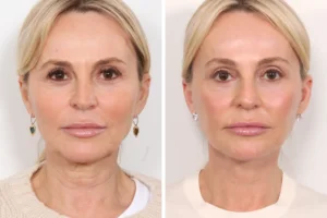 World-Class Care and Precision with Thread Lift by the Best Plastic Surgeons in Dubai