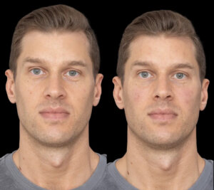 Under Eye Fillers in Dubai