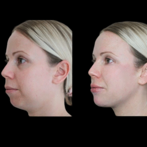 jawline filler in dubai