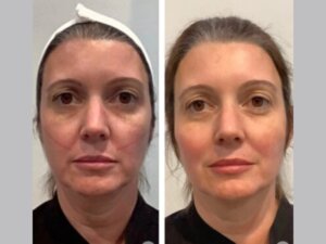 Achieve Natural Results with Thread Lift at the Best Aesthetic Clinic in Dubai