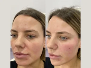 Prp Treatments in dubai