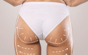 Butt Fat Transfer in Dubai