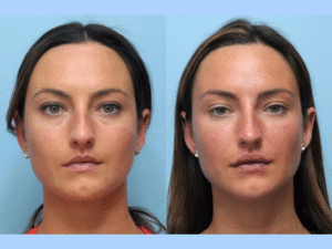 How Thread Lift in Dubai Can Transform Your Appearance