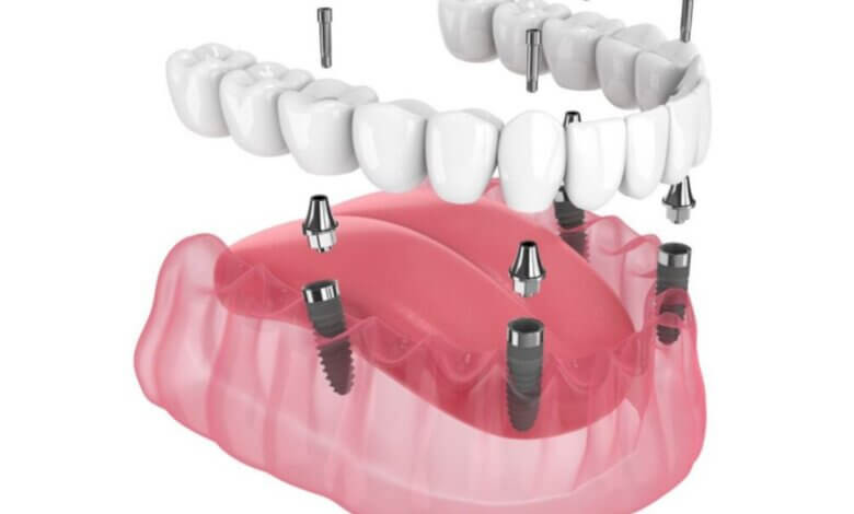 All-On-4 Dental Implants Everything You Need to Know