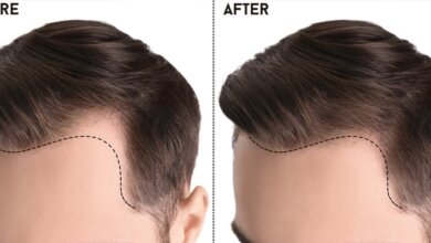 Hair Transplant in Pakistan
