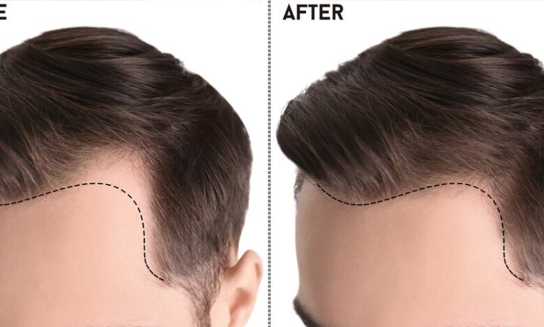 Hair Transplant in Pakistan
