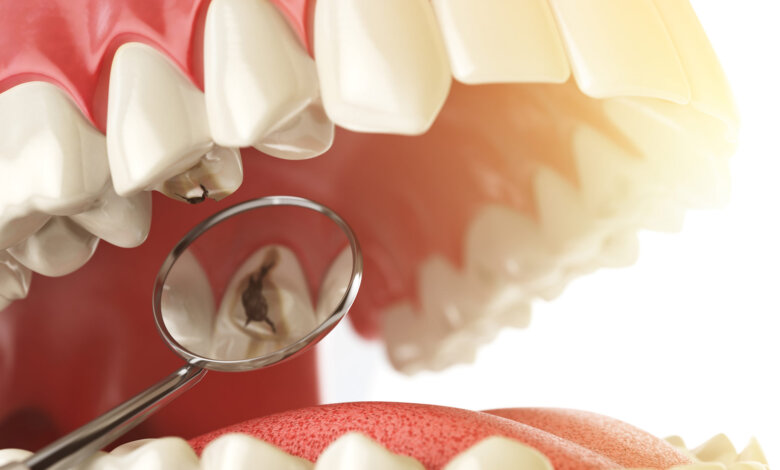 Early Cavity Signs You Should Never Ignore