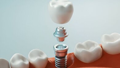 Dental Implants