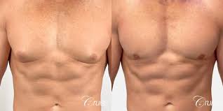 Man boobs surgery in Islamabad