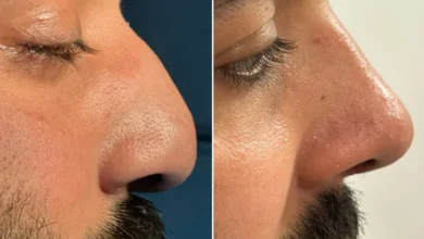 Rhinoplasty in Islamabad