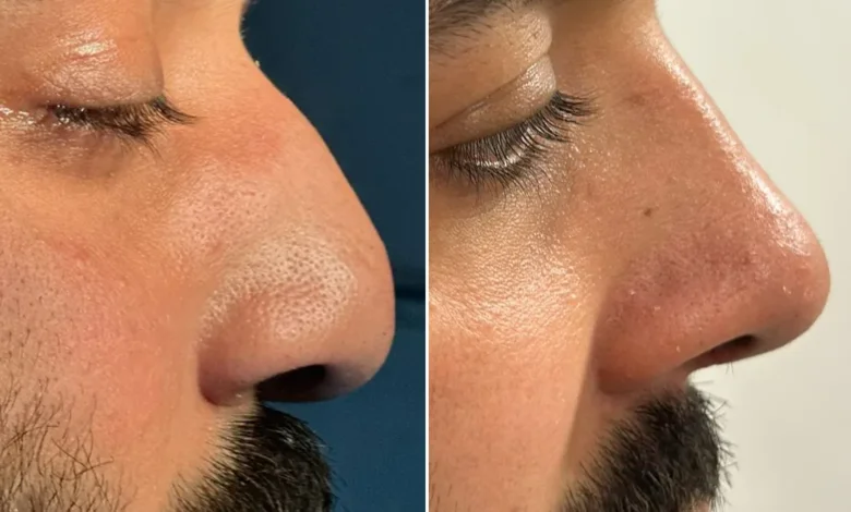 Rhinoplasty in Islamabad