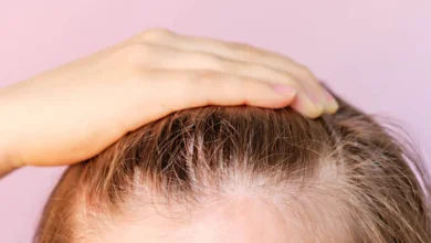 Hair transplant in Bangalore