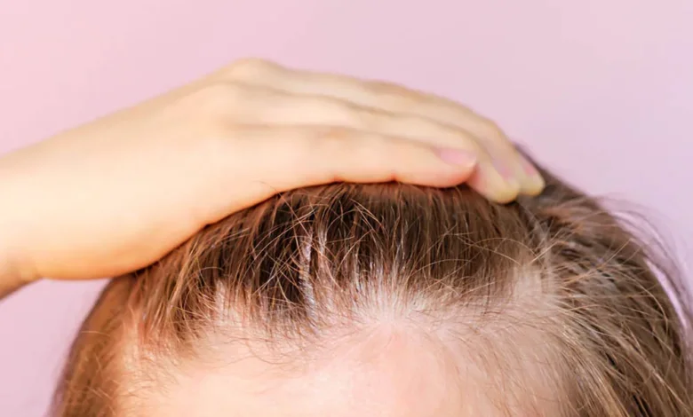 Hair transplant in Bangalore
