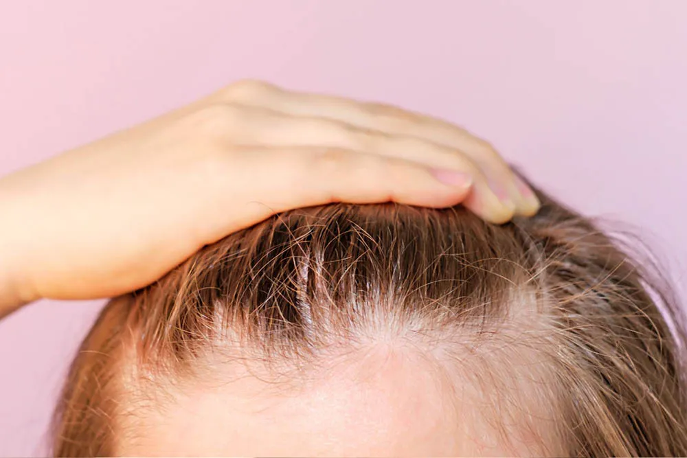 Hair transplant in Bangalore