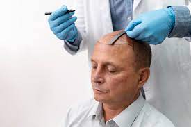 hair transplant clinic in delhi