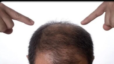 Beneficios del trasplante de cabello para hombres y mujeres