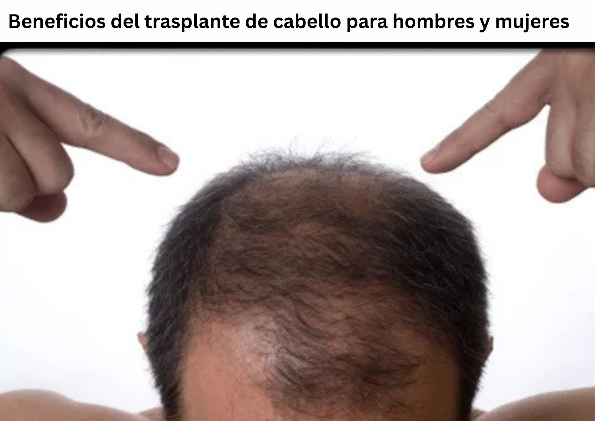 Beneficios del trasplante de cabello para hombres y mujeres