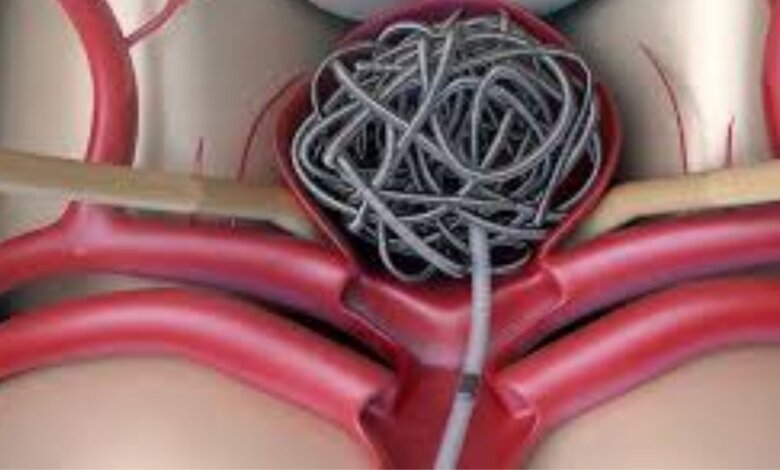 Brain Aneurysm Treatment image