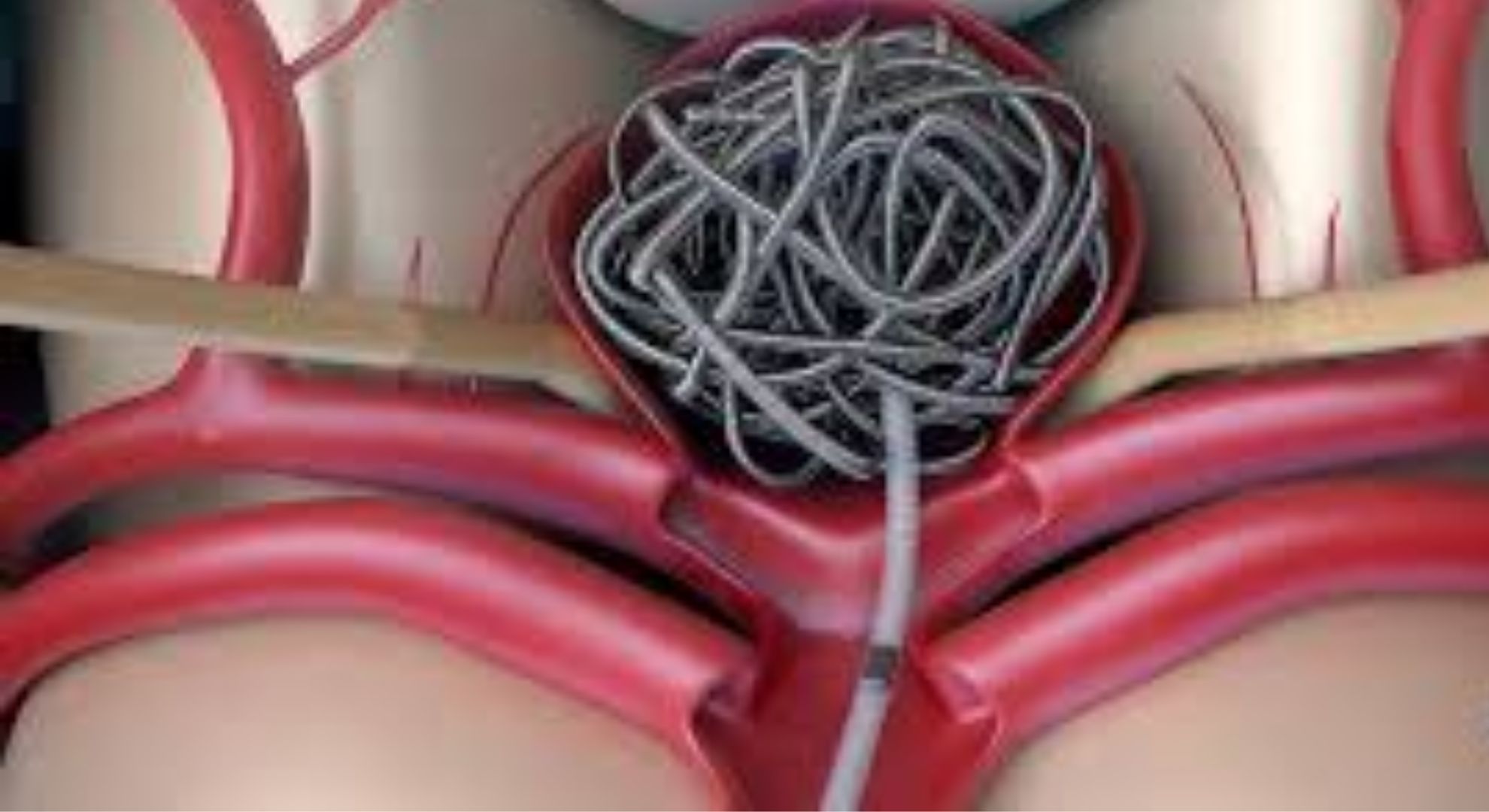 Brain Aneurysm Treatment image