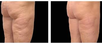 EMTONE Treatment in Clermont, FL