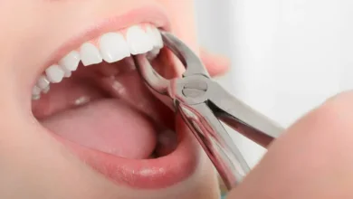 Extractions
