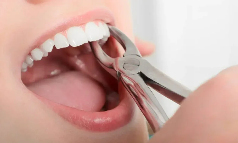 Extractions