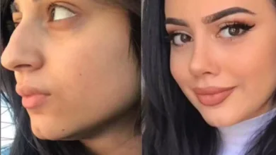 rhinoplasty in dubai