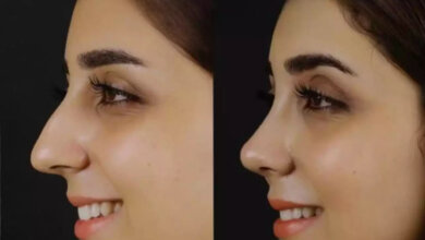 Septoplasty in Dubai
