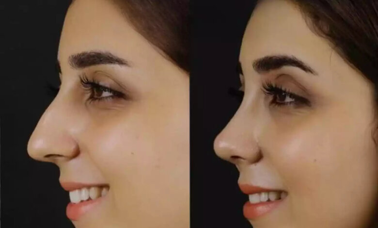 Septoplasty in Dubai