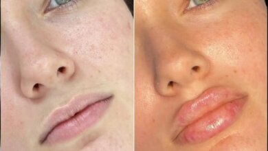 Fillers in Dubai