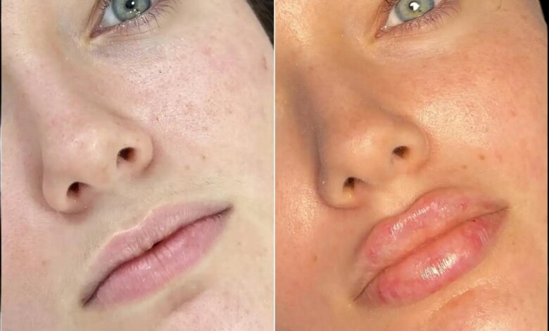 Fillers in Dubai