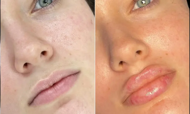 fillers in dubai
