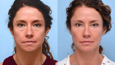 Thread Lift Treatments in Dubai: Face Contouring for Natural-Looking Results