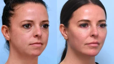 Thread Lift in Dubai: Natural Results, Minimal Downtime