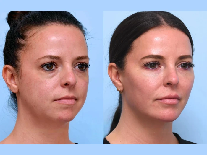 Thread Lift in Dubai: Natural Results, Minimal Downtime