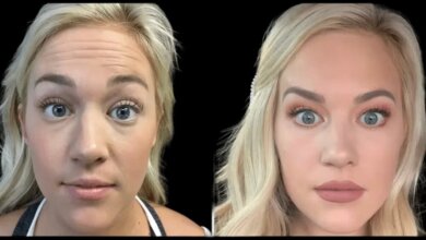 Botox in dubai