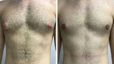 Frequently Asked Questions Answered by the Best Gynecomastia Surgeon in Dubai