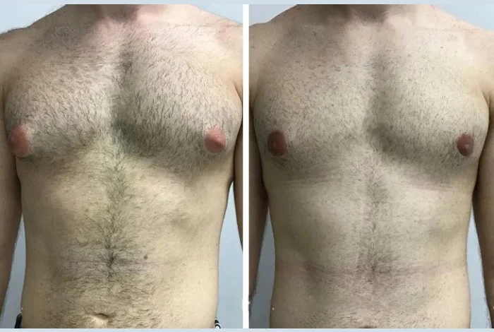 Frequently Asked Questions Answered by the Best Gynecomastia Surgeon in Dubai
