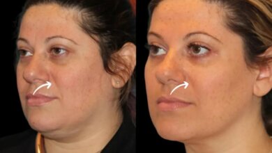 sculptra fillers in dubai