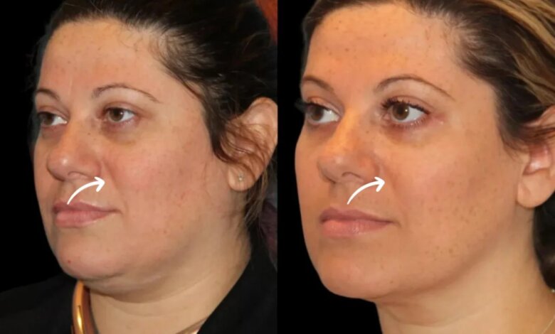 sculptra fillers in dubai