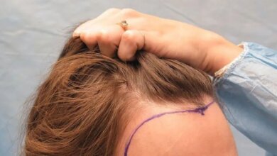 How a Hairline Transplant Can Restore Your Natural Look