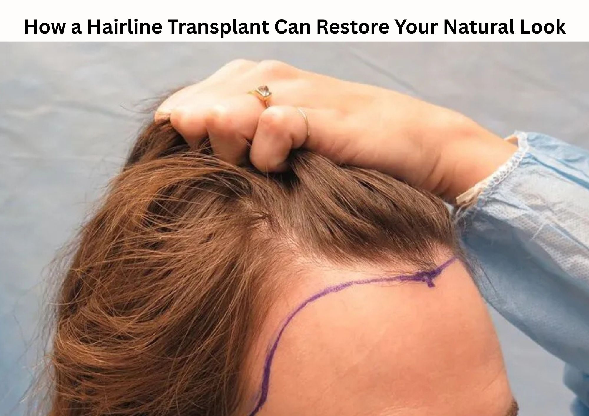 How a Hairline Transplant Can Restore Your Natural Look