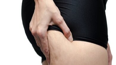 How does liposuction work to release fat and reduce cellulite (1)