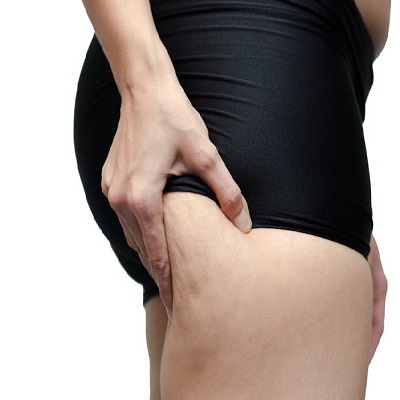 How does liposuction work to release fat and reduce cellulite (1)