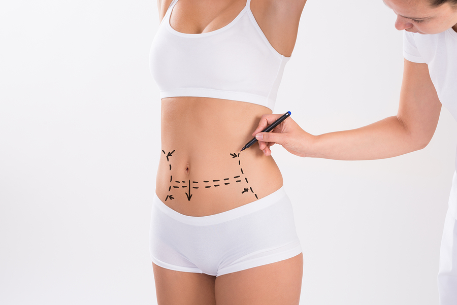 Insurance and Liposuction What’s Covered and What’s Not