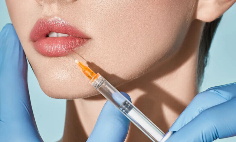 Lip Filler Injections Trends, Techniques, and What’s New