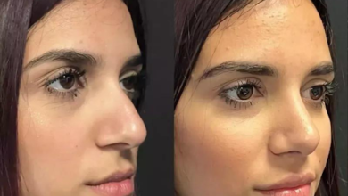 Rhinoplasty in Dubai